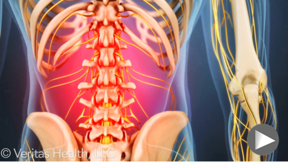 lumbar herniated disc video link